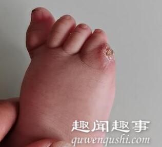 医生给幼儿小脚趾手术失误致截肢 到底是手术失误什么情况?