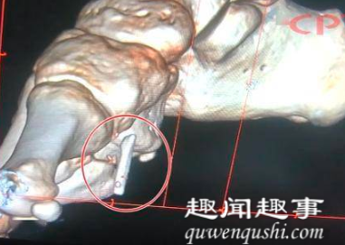 近日,重庆一小伙做脚伤手术后1个月走路仍一瘸一拐,到医院检查吓坏了。