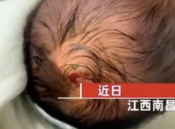 出生仅4天婴儿被蜱虫咬伤 内幕曝光简直太恐怖了