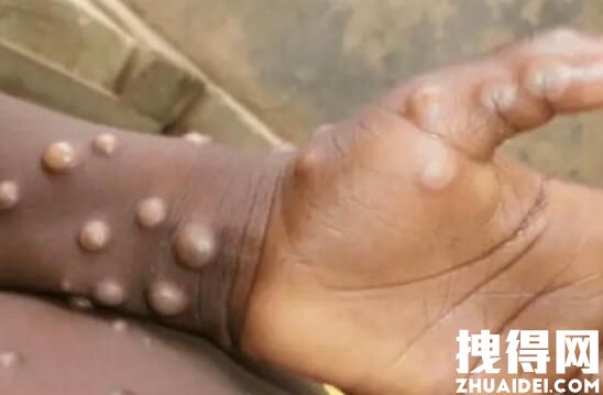 专家称重庆猴痘疫情传播风险很低 究竟是怎么回事？