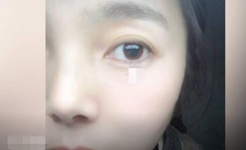 女子左眼瞳孔变大2倍找不到病因 她的瞳孔0.7cm
